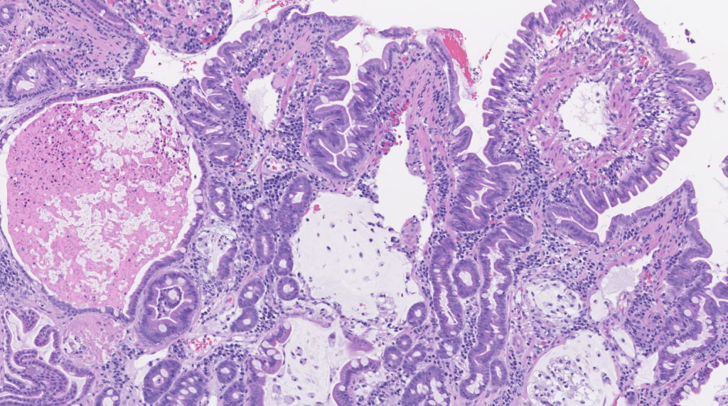 Histology image from a duodenum with lacteal dilation and crypt proteinosis. H&E stain. 