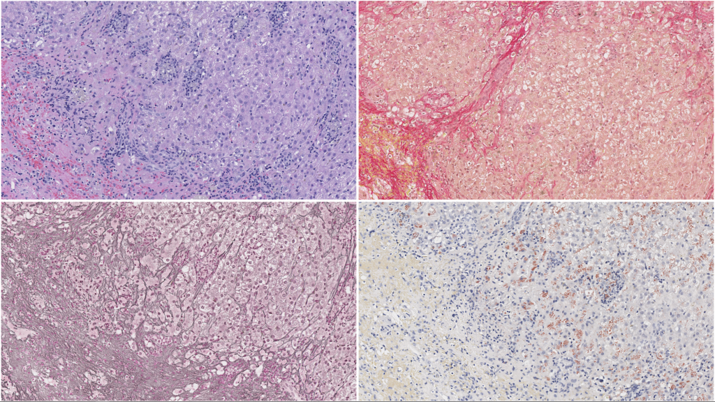 Histology of a liver with inflammation, fibrosis, and accumulation of copper. Panel of stains including H&E, Picrosirius red, Reticulin, and Copper.