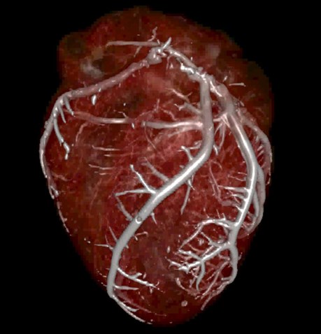 Barium Heart