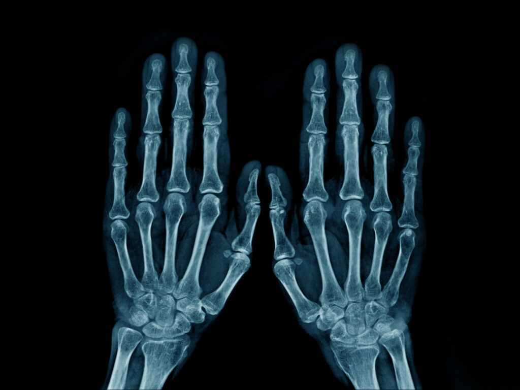 x-ray image hand and fingers