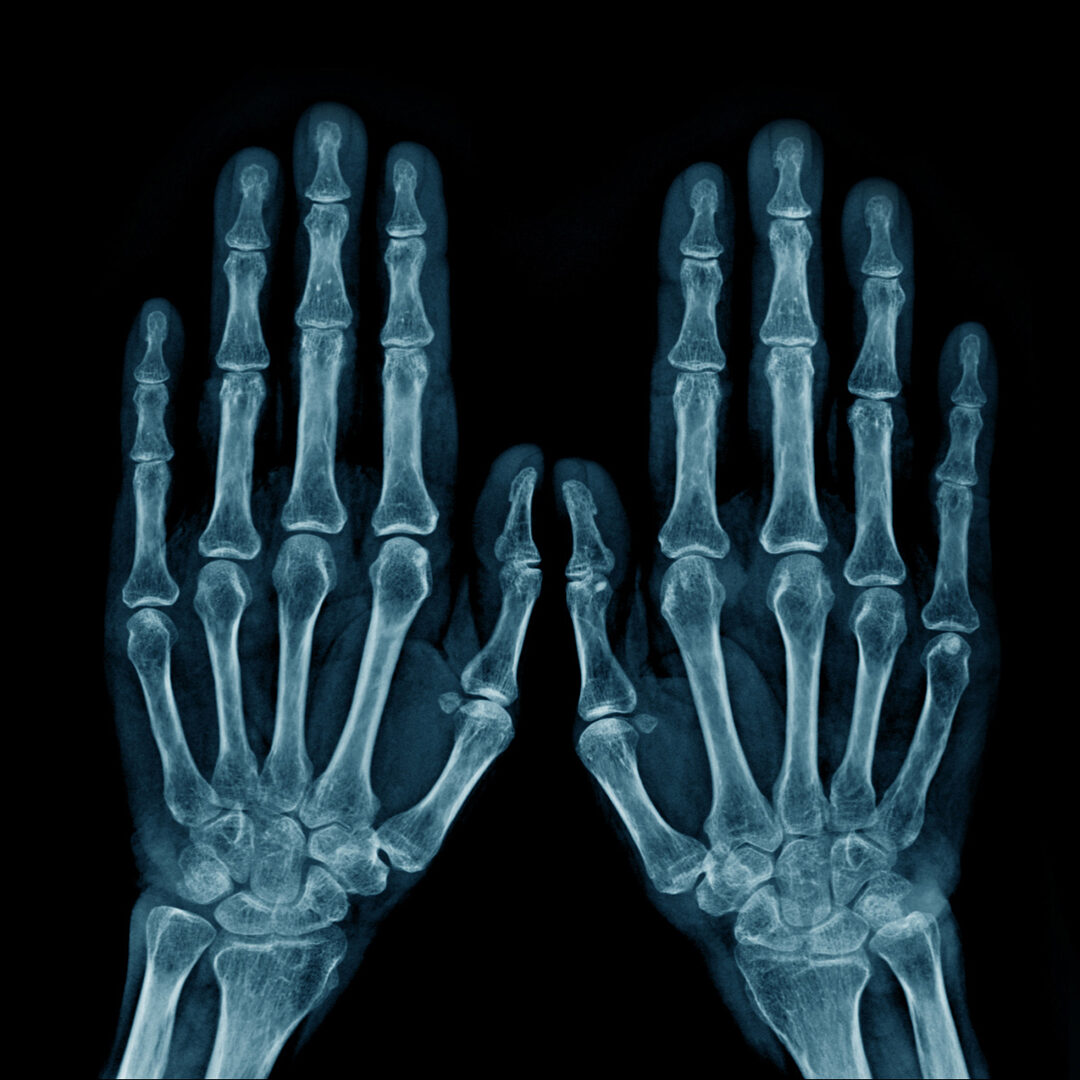 x-ray image hand and fingers