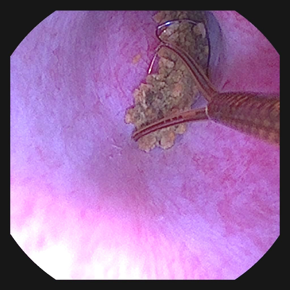 Scope view inside Francis' urethra